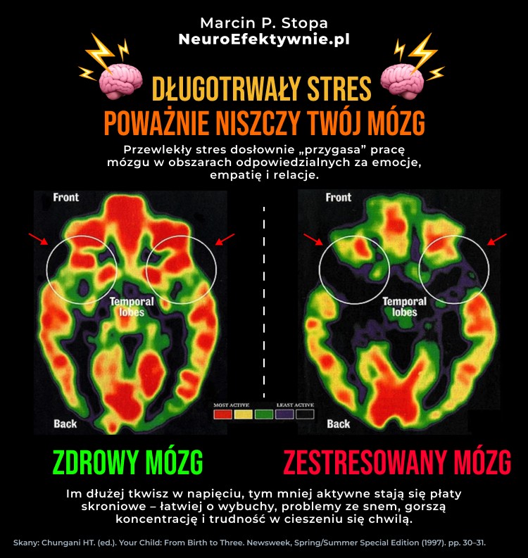 Porównanie skanów mózgu pokazujące wpływ długotrwałego stresu na aktywność płatów skroniowych - zdrowy mózg vs zestresowany mózg