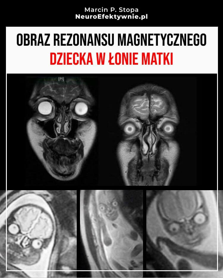 Obraz rezonansu magnetycznego płodu w łonie matki - badanie MRI ciąży pokazujące dziecko w macicy w różnych projekcjach