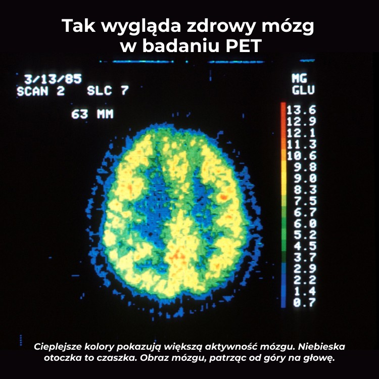 Badanie PET zdrowego mózgu - przekrój poprzeczny pokazujący rozkład aktywności metabolicznej glukozy w mózgu, cieplejsze kolory żółte i pomarańczowe oznaczają wyższą aktywność obszarów mózgowych